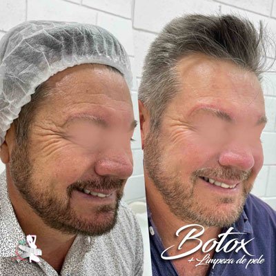 botox-barato-em-curitiba