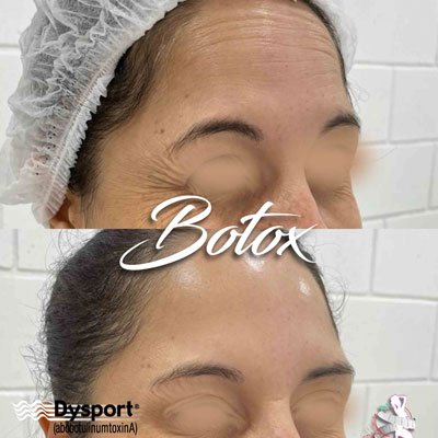 botox-em-sanbta-felicidade-curitiba