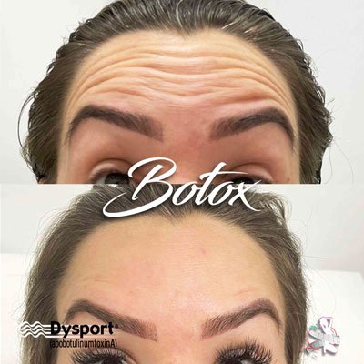botox-nutri-linda-1